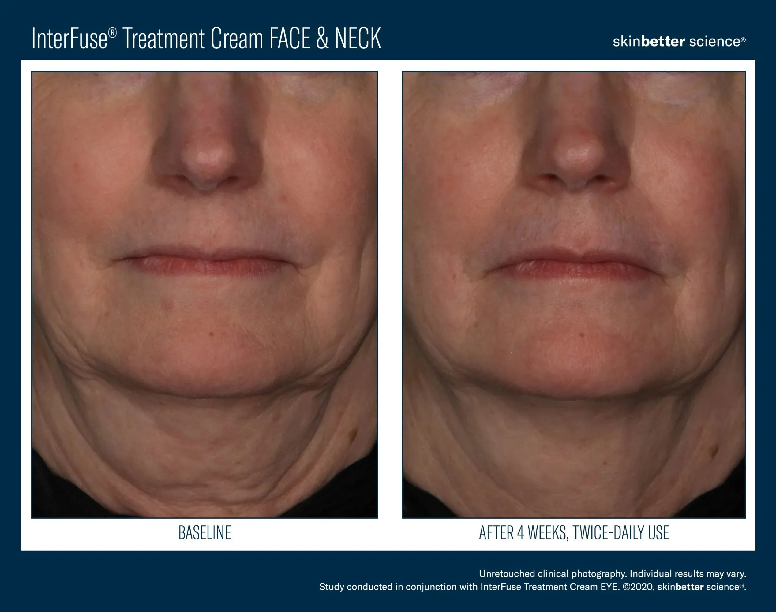 InterFuse Treatment Cream FACE & NECK